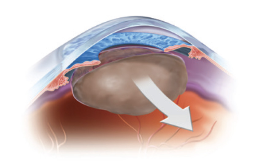 Cataract removal
